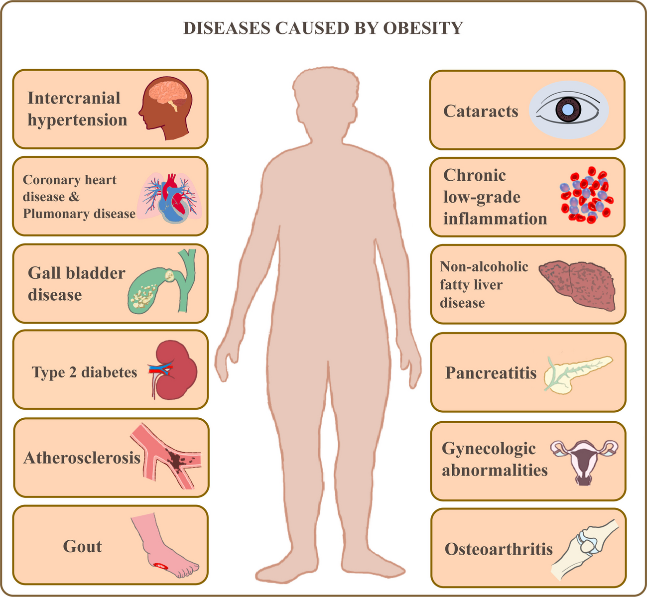 Autoimmune mechanisms and inflammation in obesity-associated type 2 diabetes, atherosclerosis, and non-alcoholic fatty liver disease