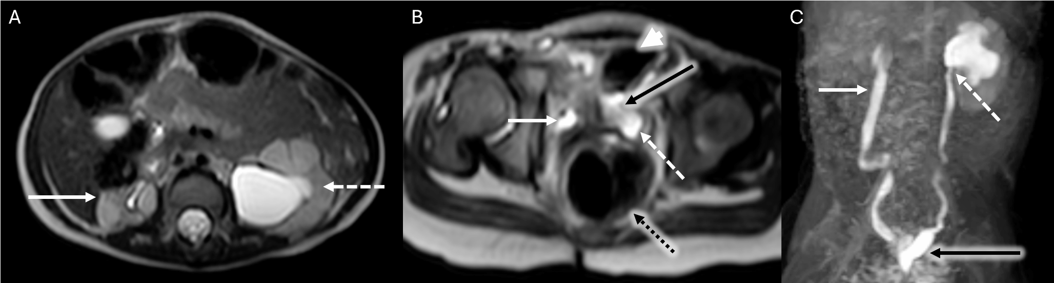 Urinary Bladder Agenesis in a Child: An Uncommon Congenital Anomaly of the Urinary Tract