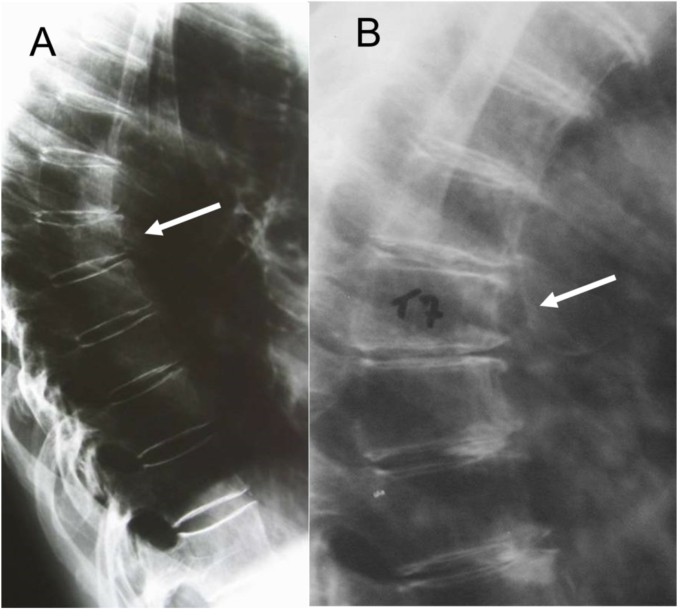 Fratture vertebrali da osteoporosi: diagnosi differenziale
