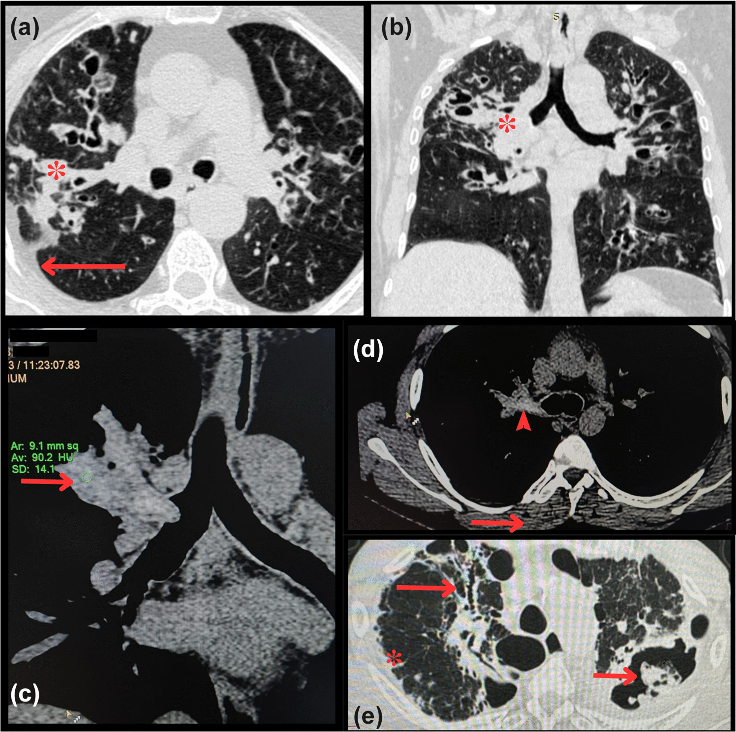 Allergic Bronchopulmonary Aspergillosis: What's New
