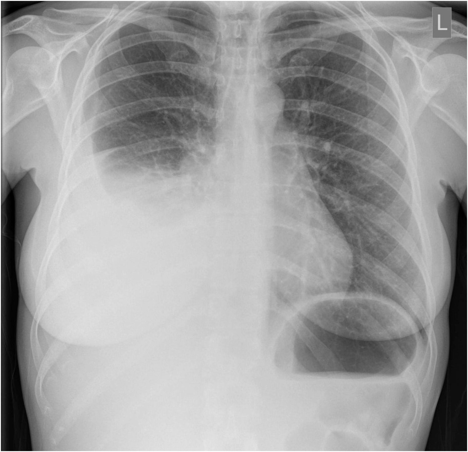 Tuberculosis Related Pleural Effusion: An Update