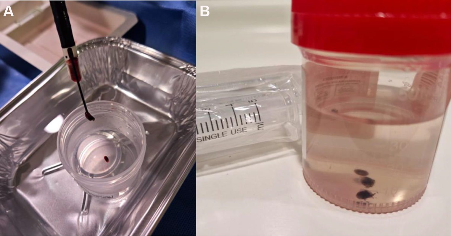 Cryobiopsies: Update on the Tools, Techniques, and Evidence for Malignancy, Interstitial Lung Diseases, and Lymph Nodes