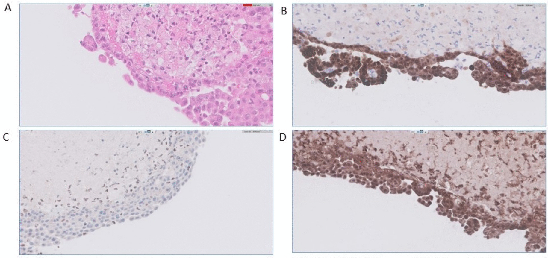 Non-Specific Pleuritis: An Update