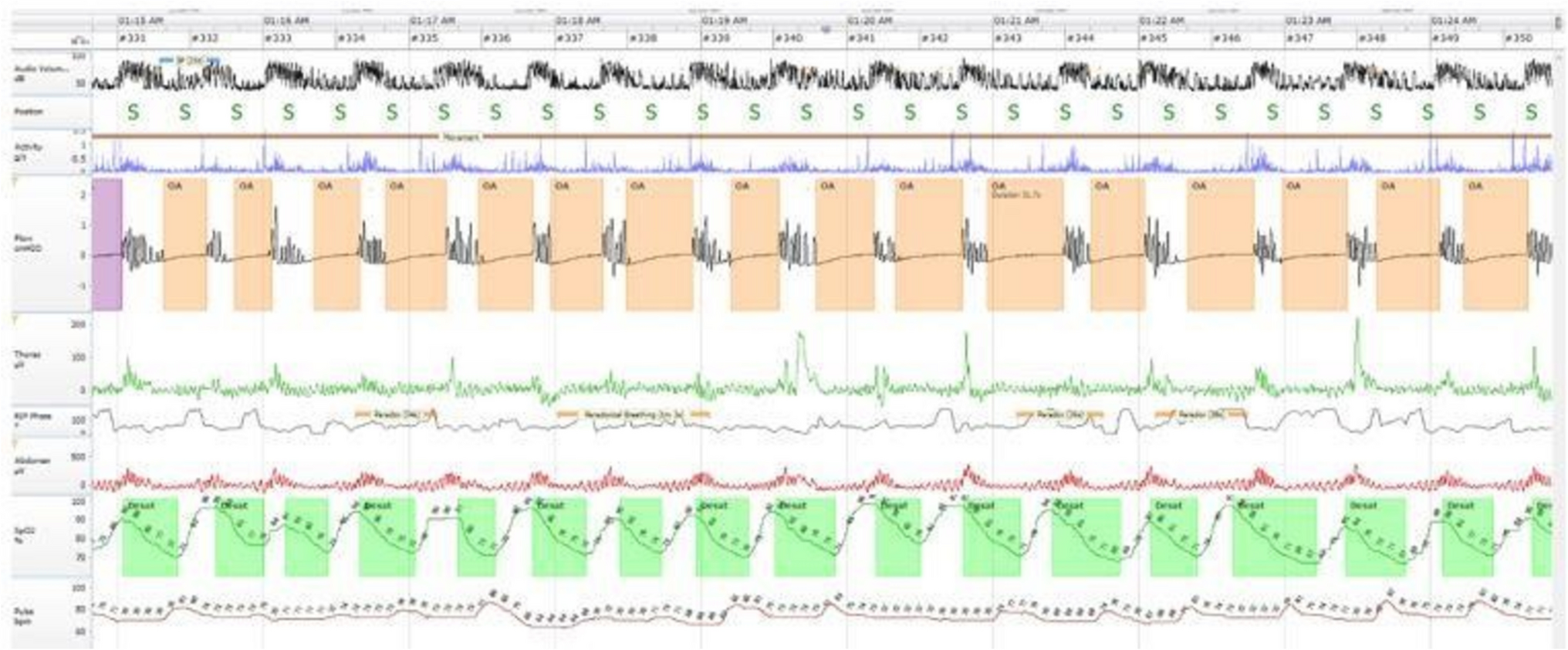 Current Perspectives in Treatment of Obstructive Sleep Apnea with Mandibular Advancement Devices: A Narrative Review