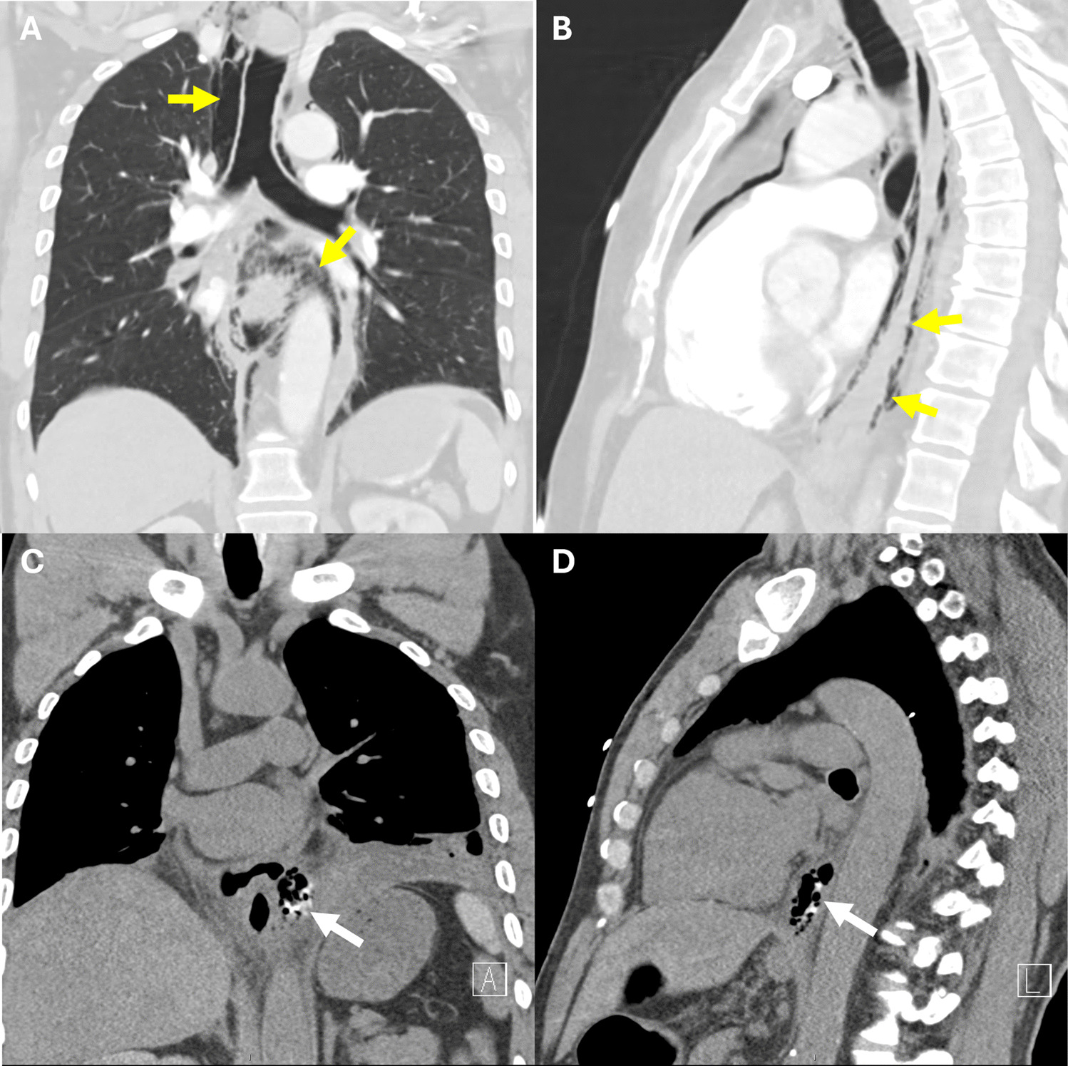 CT of the esophagus in the ER: what you need to know and what you need to remember