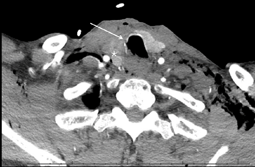 Imaging of tracheobronchial and laryngeal injuries
