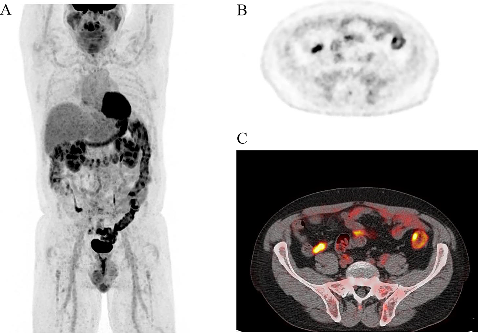Assessing the utility of FDG PET/CT study in diagnosis of early acute appendicitis