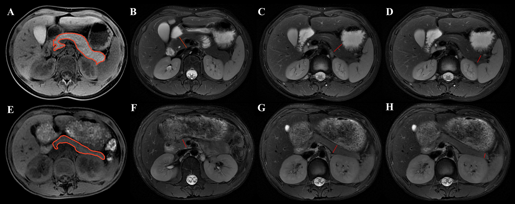 Effects of diabetic ketoacidosis, islet cell function, and age of onset on pancreas size, morphology, and exocrine function in children with type 1 diabetes: an abdominal MRI study