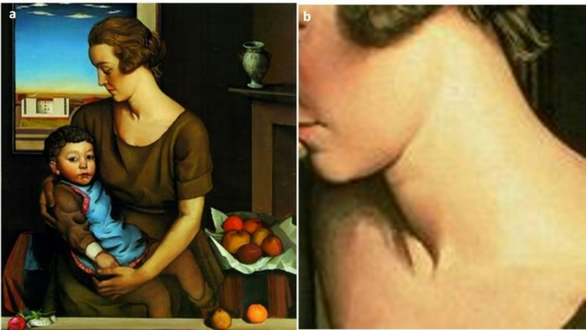 A model with thyroid swelling portrayed by Achille Funi in the painting “maternità”