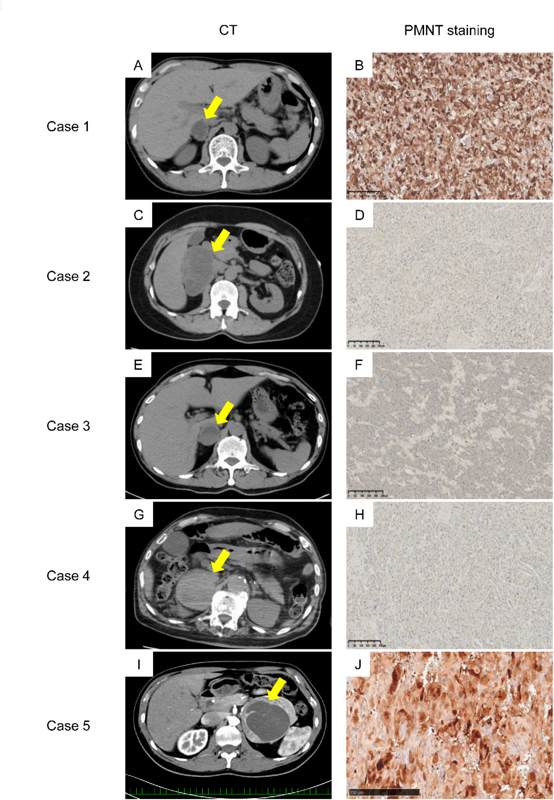 Intracystic catecholamine variations in cystic pheochromocytoma