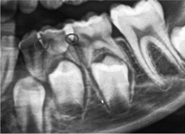 Root resorption pattern and root length of mandibular primary molars in children: a cross-sectional radiographic study