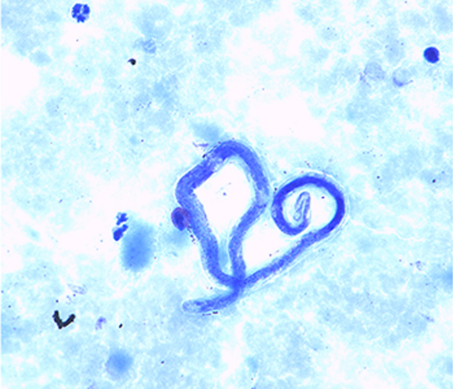 Treatment of loiasis: a review of clinical management recommendations