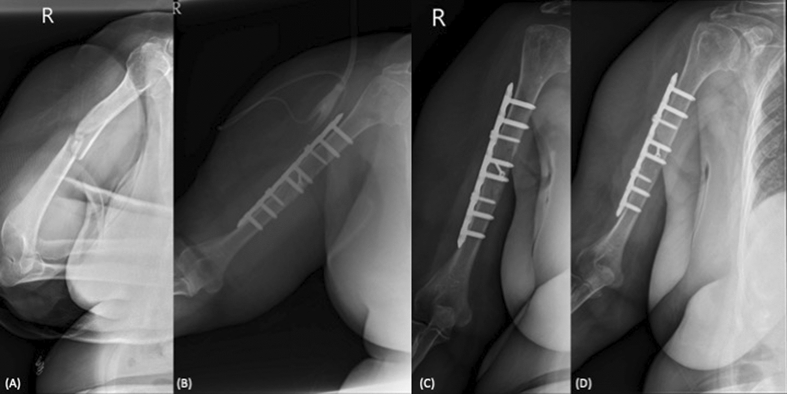 Risk factors associated with delayed union after open reduction and plate fixation for humeral diaphyseal fractures