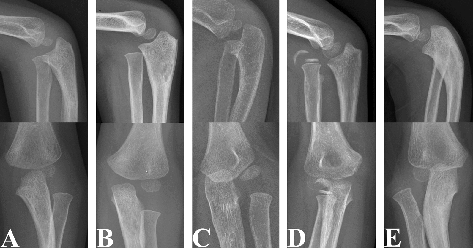 Risk factors for the development of heterotopic ossification of the elbow in children with untreated chronic Monteggia fractures: a radiographic review of 274 cases