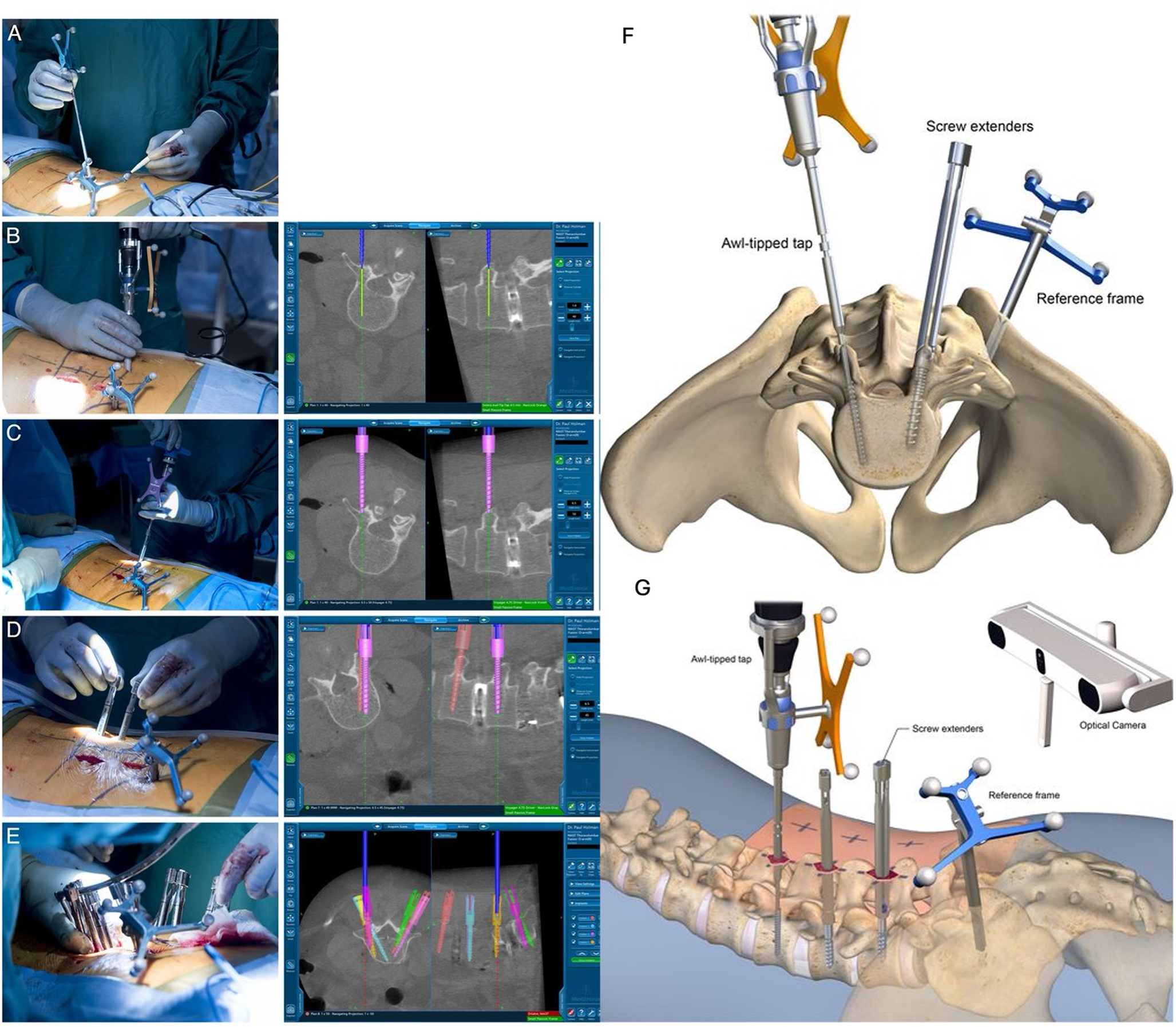 Artificial Intelligence in Spine Surgery: Imaging-Based Applications for Diagnosis and Surgical Techniques
