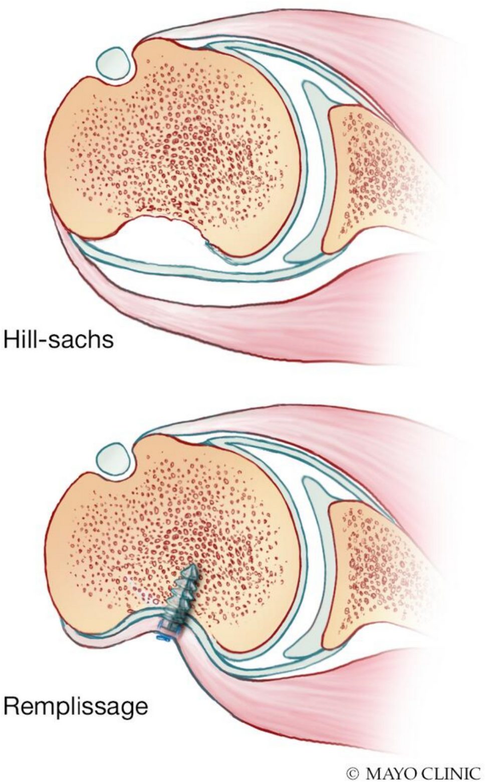 An Evidence-Based Approach to Indication for Remplissage