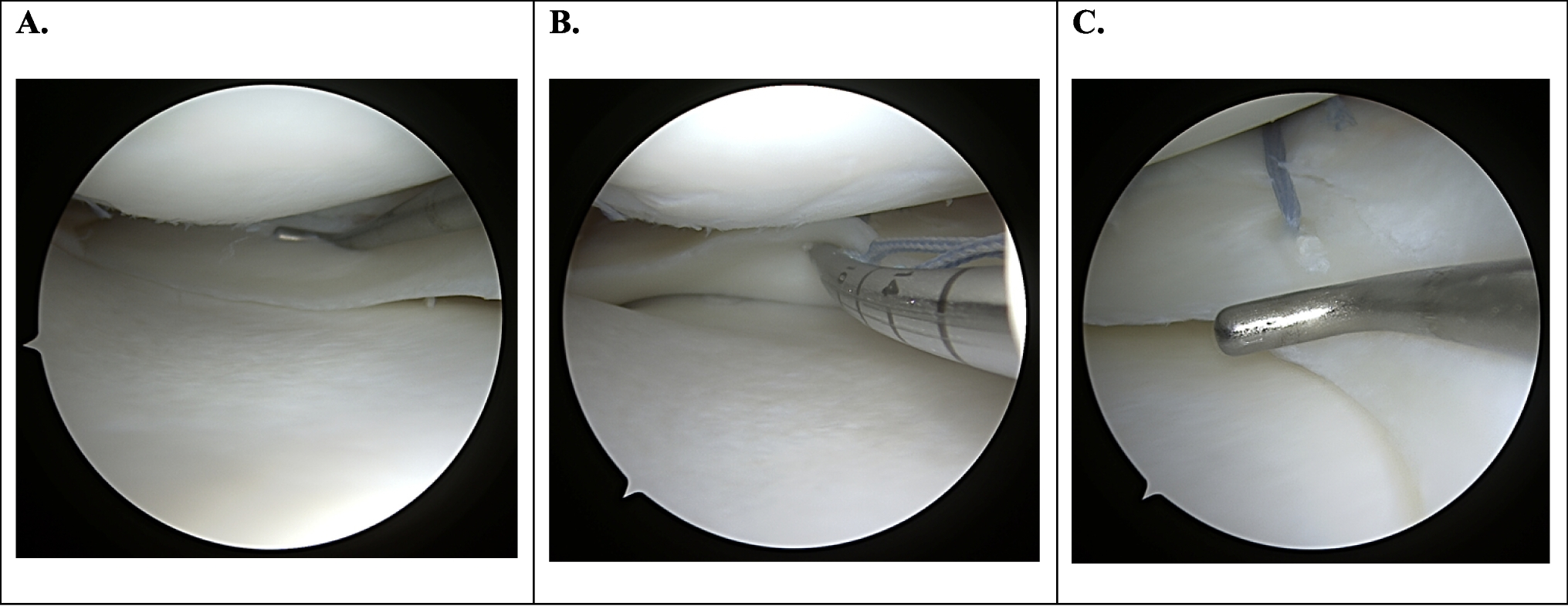 Long-Term Results for Meniscus Repair
