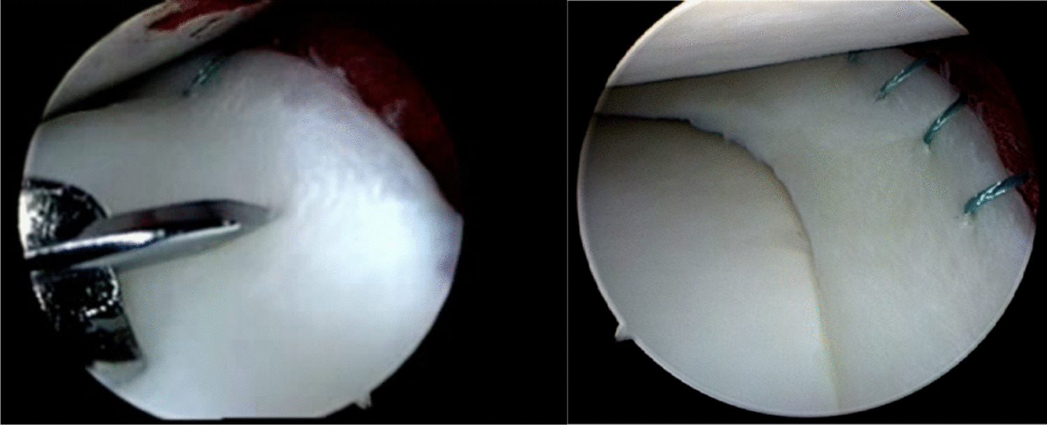 A Review of Revision Meniscal Repair: Clinical Considerations and Outcomes