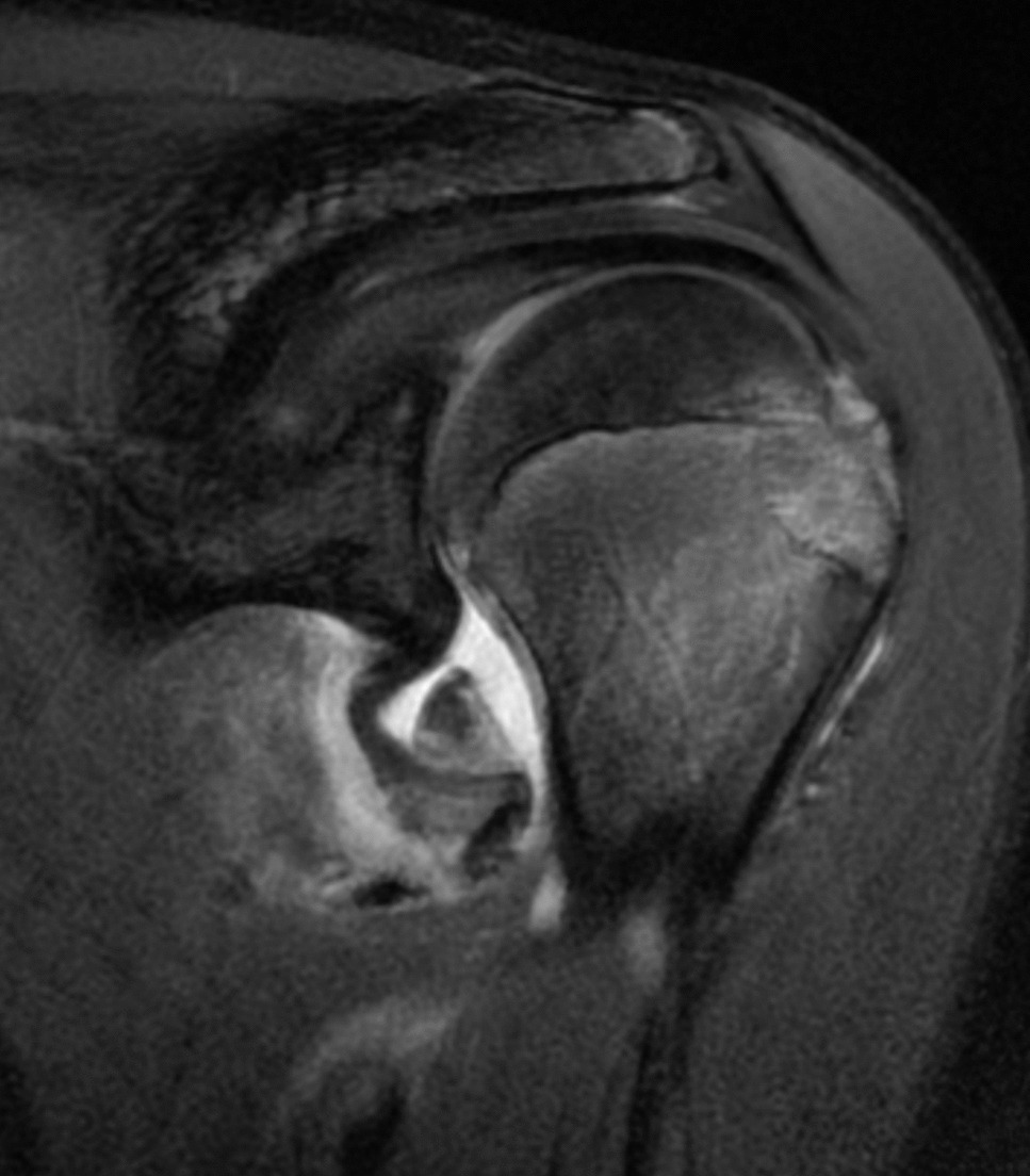 Surgical Management of Humeral Avulsion of the Glenohumeral Ligament Injuries: Indications, Treatment Strategies, and Outcomes