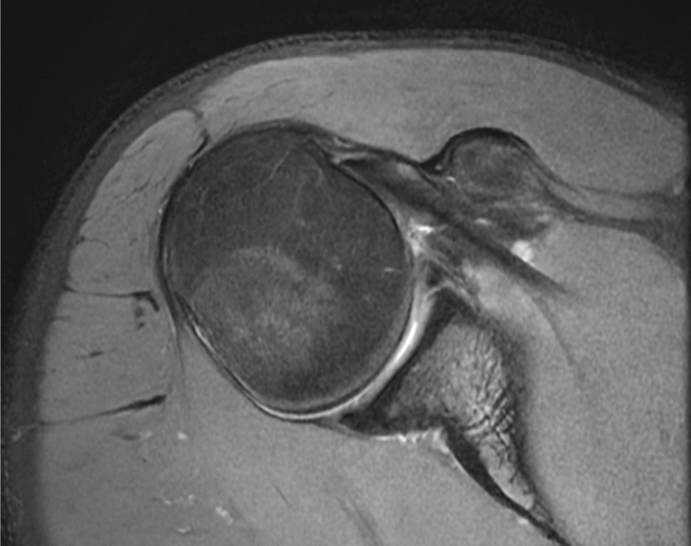 Approach to Treating Patients after First-time Anterior Shoulder Instability: What Does the Evidence Say?