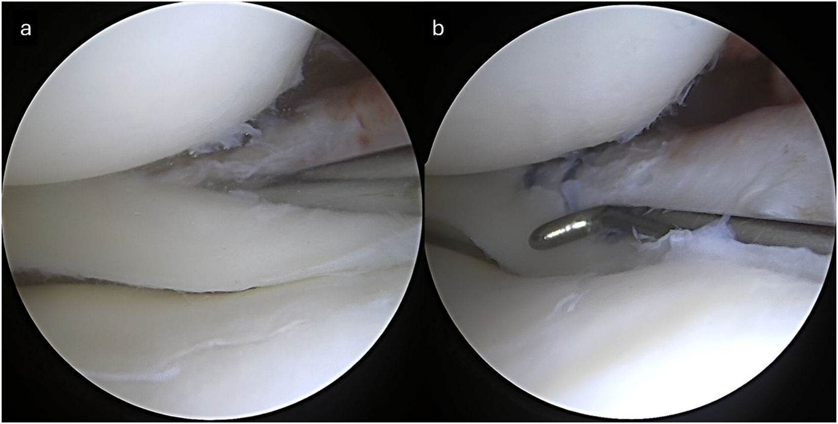 Biomechanics of Meniscus Tears and Repair Techniques