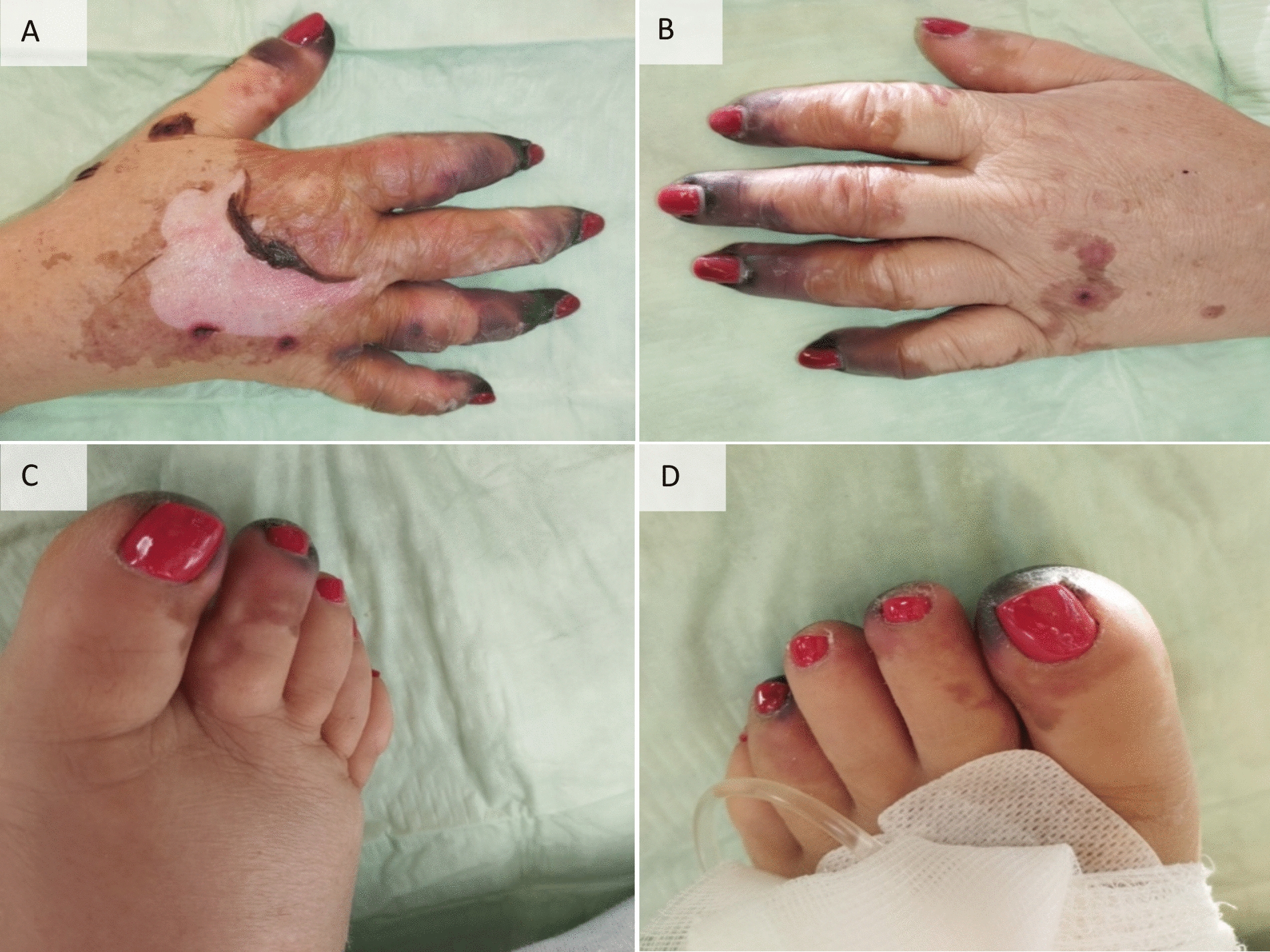 Acral necrosis in a 62-year-old female after travelling to Equatorial Guinea