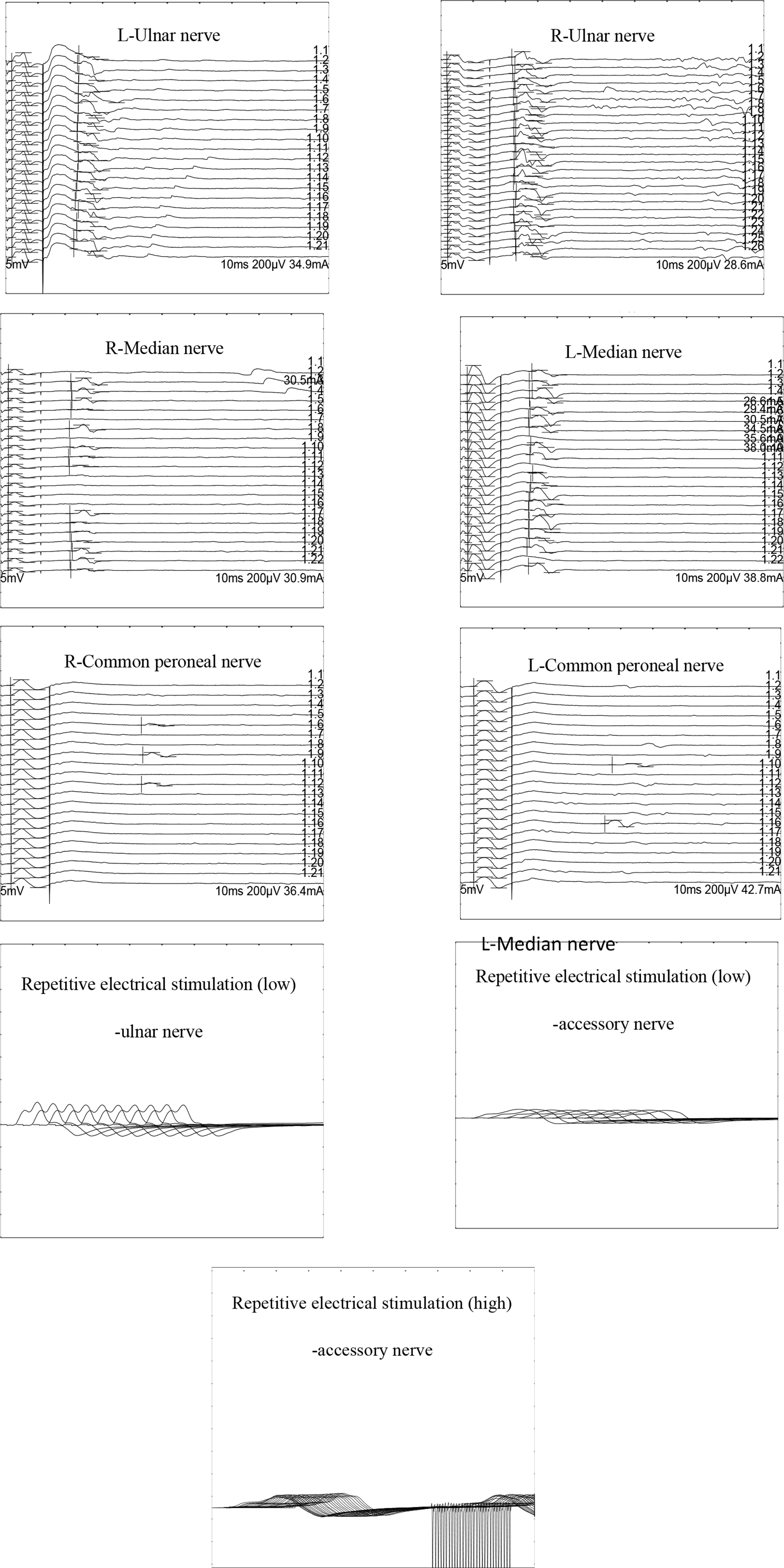 Dysphagia and Muscle Weakness Caused by Botulinum Toxin Poisoning after Cosmetic Injection: Three Case Reports and Clinical Warnings