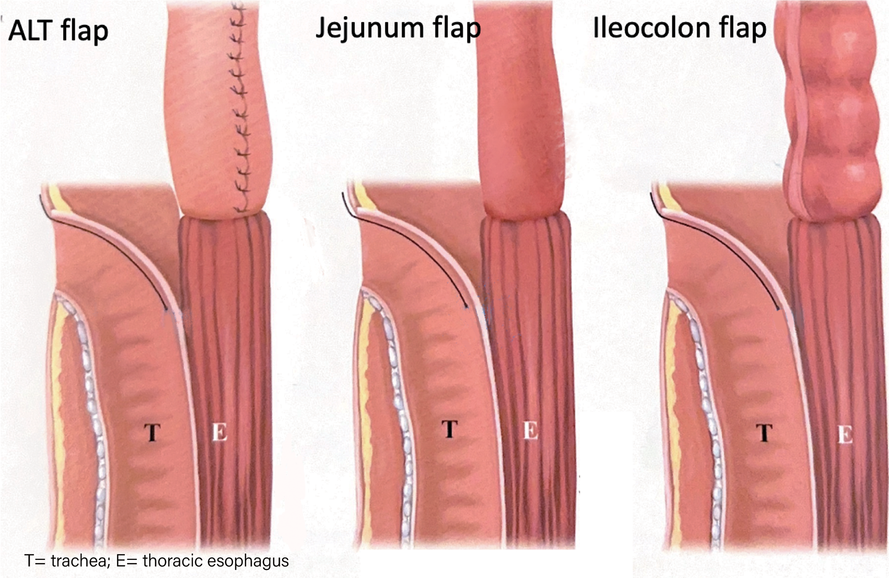Comparison of the Swallowing Function After Reconstruction of Cervical Esophagus with Jejunum, Ileocolon or Skin Flap: Method of Physiotherapy for Deglution and Long Term Follow-Up