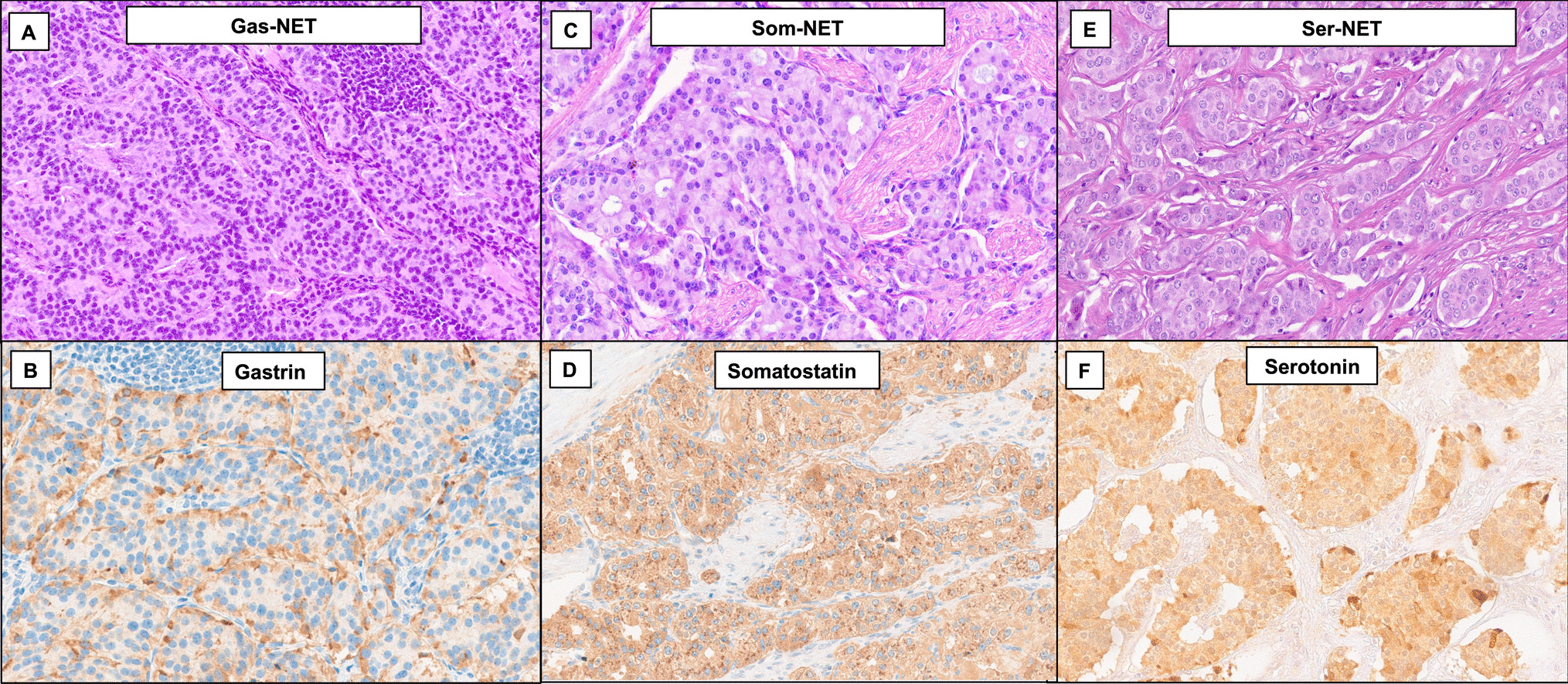 Clinicopathological Correlates of Hormone Expression-Based Subtypes of Non-Functioning Duodenal/Ampullary Neuroendocrine Tumors: A Multicenter Study of 151 Cases