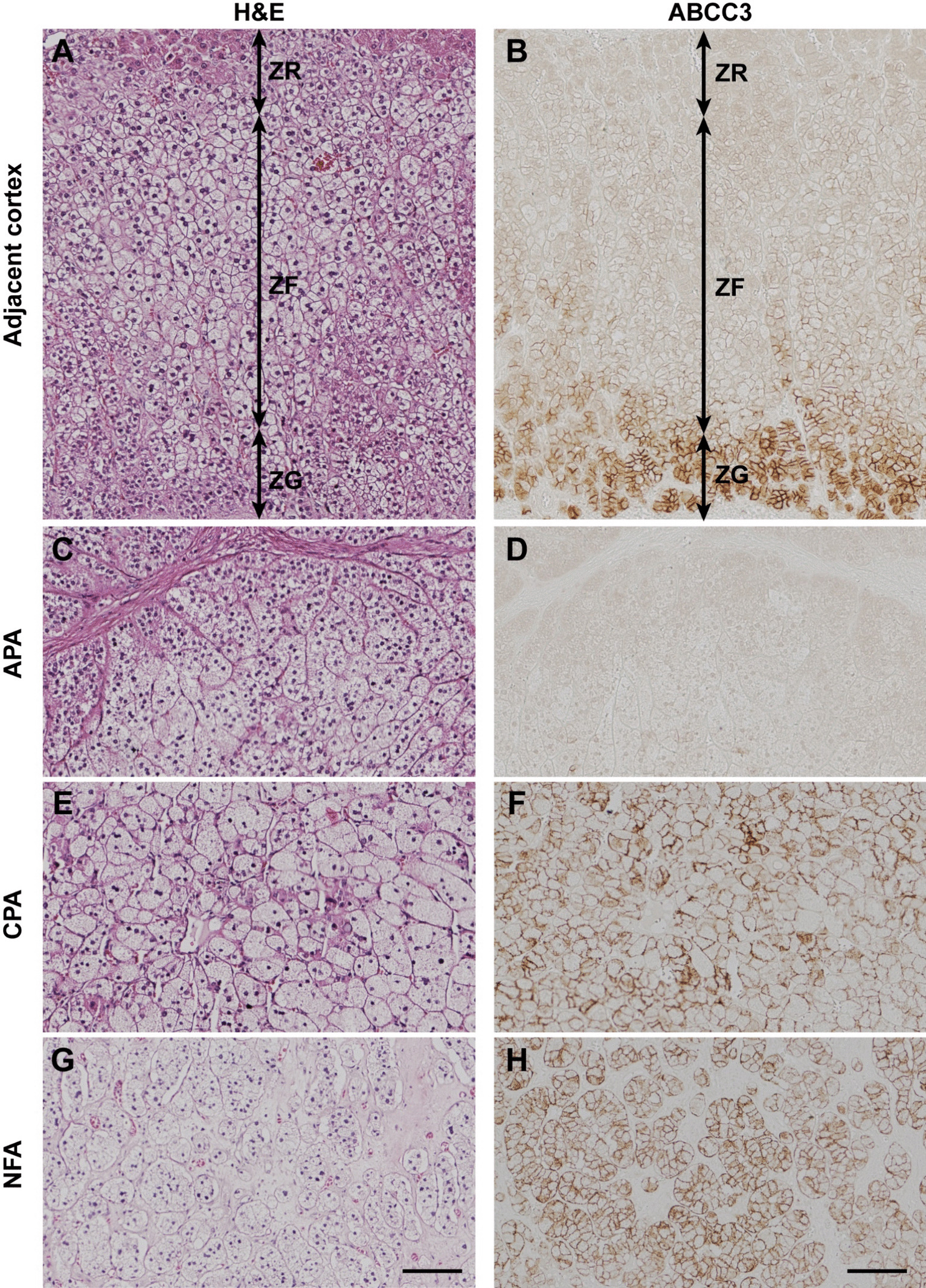 ABCC3 Is a Differential Marker of CYP11B2-Negative Zona Glomerulosa Cells in Human Adrenal Cortex