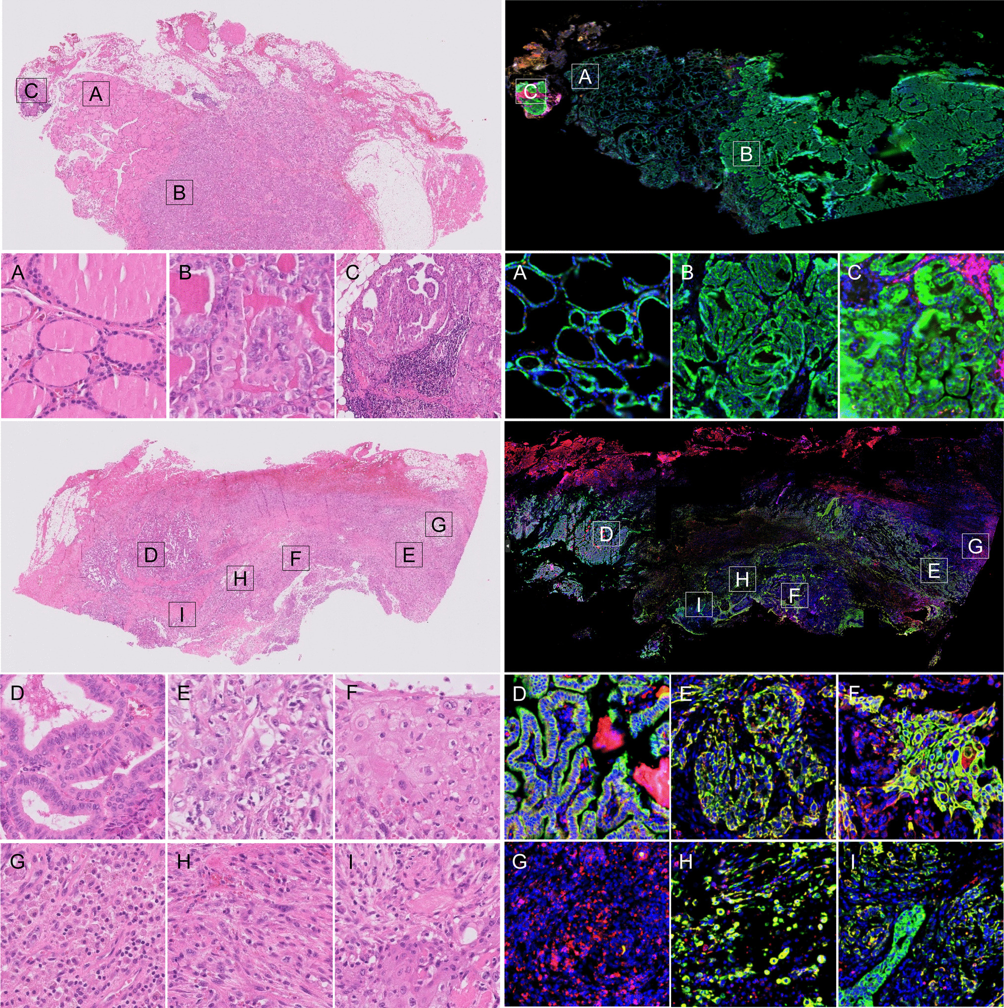 Identification of Specific Biomarkers for Anaplastic Thyroid Carcinoma Through Spatial Transcriptomic and Immunohistochemical Profiling