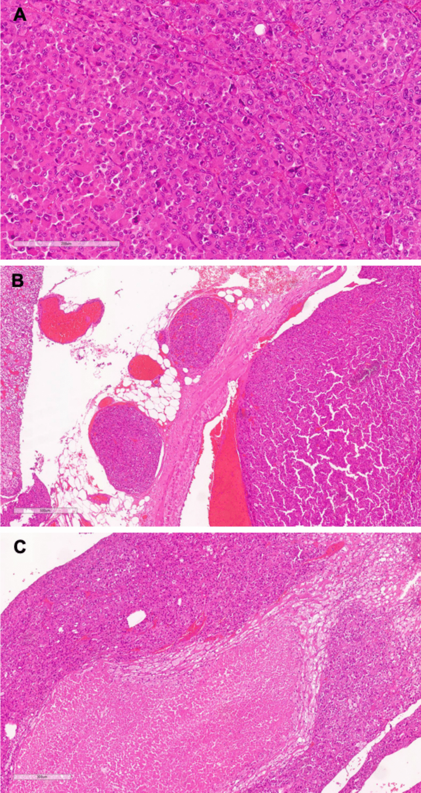 Multicentric Retrospective Analysis of Oncocytic Adrenocortical Carcinoma: Insights into Clinical and Management Strategies