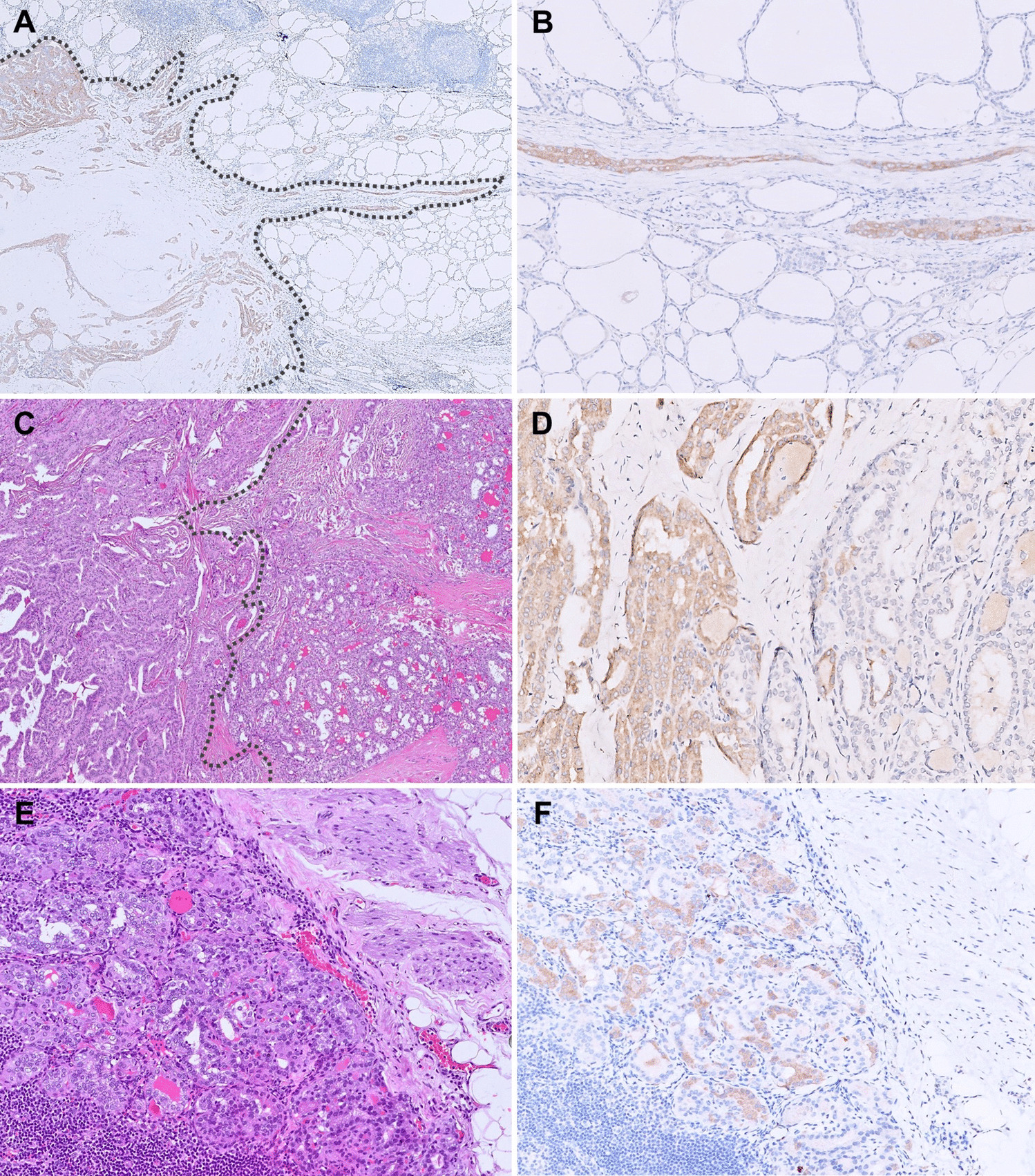 Next-Generation Immunohistochemistry in Thyroid Neoplasm: A Practical Review on the Applications in Diagnosis and Molecular Classification