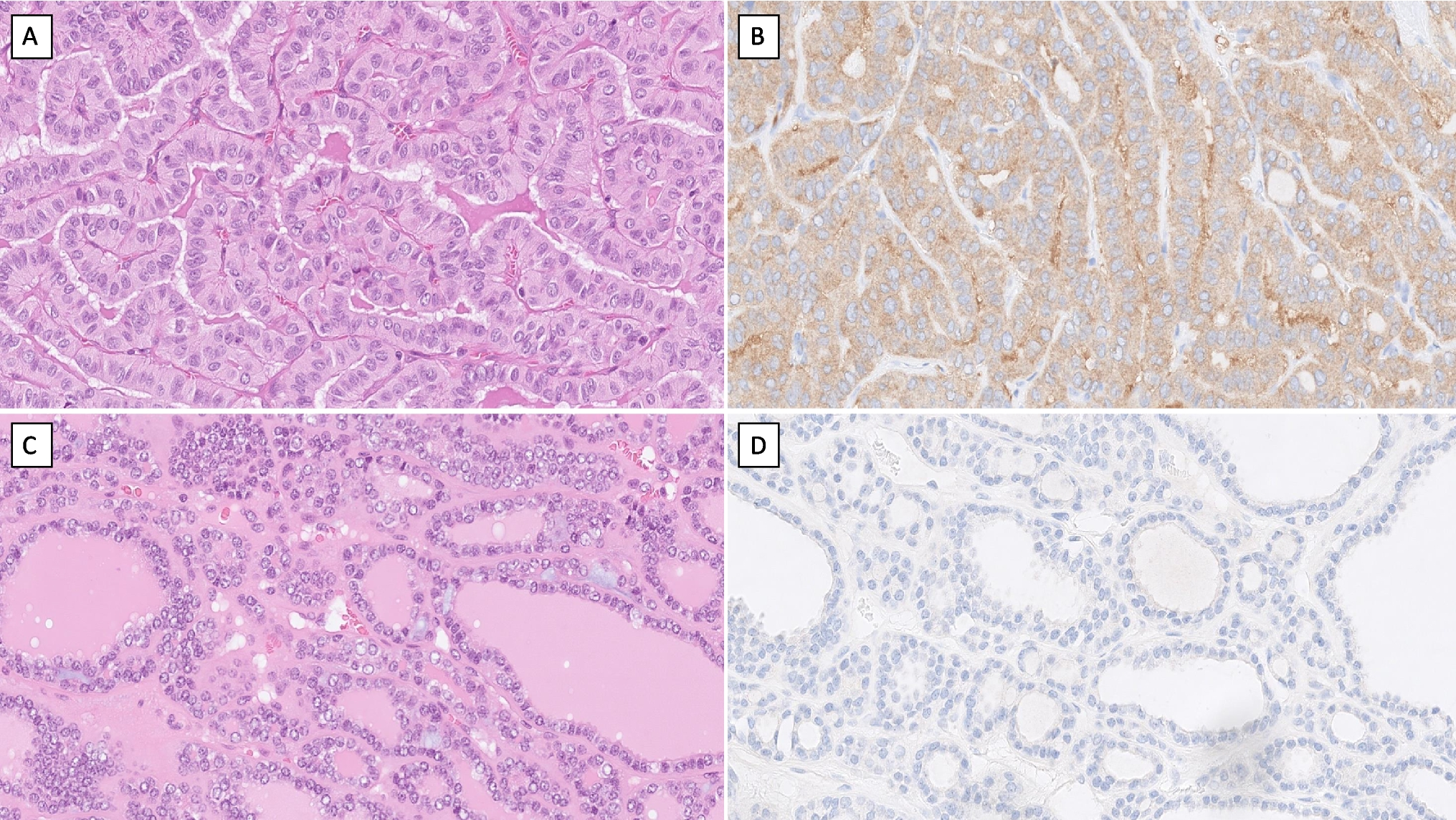 Comprehensive Gene Expression Analysis in Papillary Thyroid Carcinoma Reveals a Transcriptional Profile Associated with Reduced Radioiodine Avidity