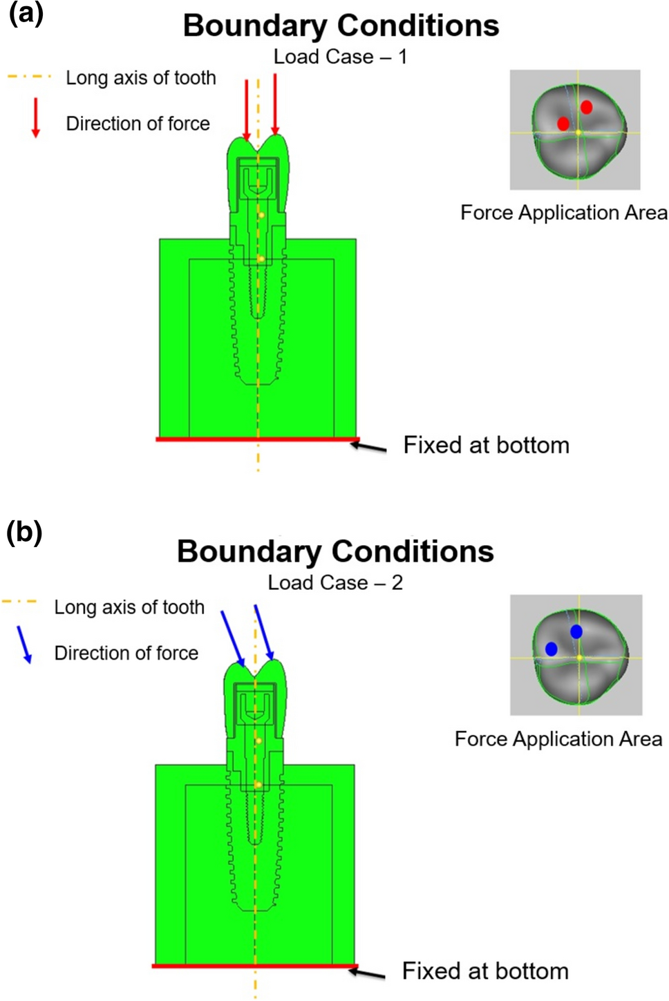 Stress Distribution in Peri-implant Bone of Implants Restored with Screw, Cement, and Cement-Screw Retained Crowns Using Three Crown Materials: a Three-dimensional Finite Element Analysis
