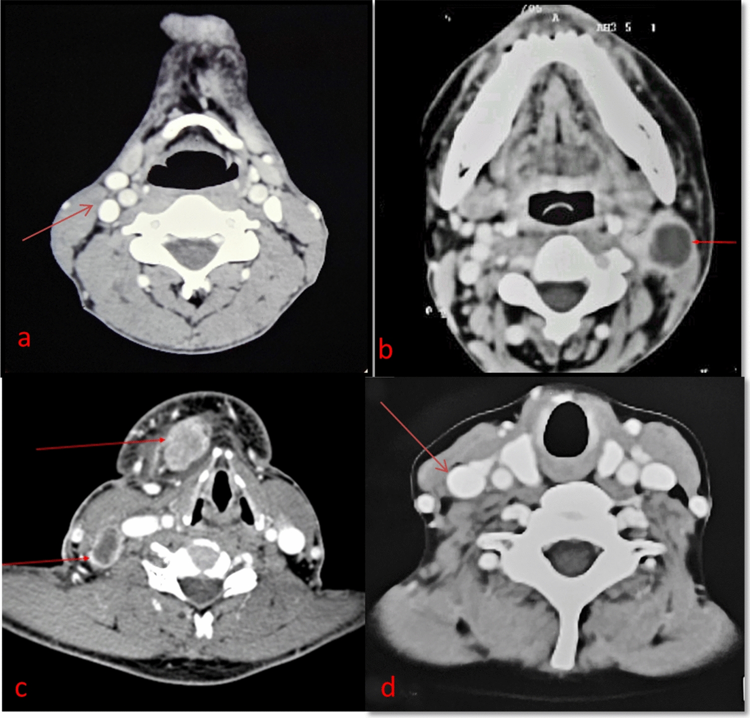 Is Oral Squamous Cell Carcinoma Masked in the Presence of Oral Submucous Fibrosis? An Observational Radio-Pathological Study