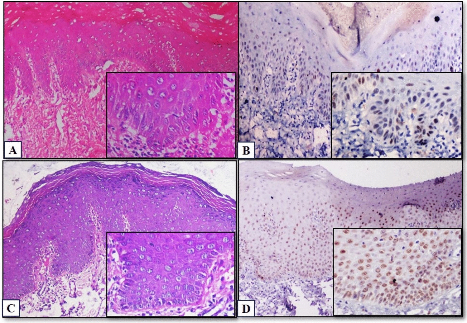 Analysing the Stemness of Pluripotent Cells by Immunoexpression of SOX2 in Varying Grades of Oral Epithelial Dysplasia and Oral Squamous Cell Carcinoma