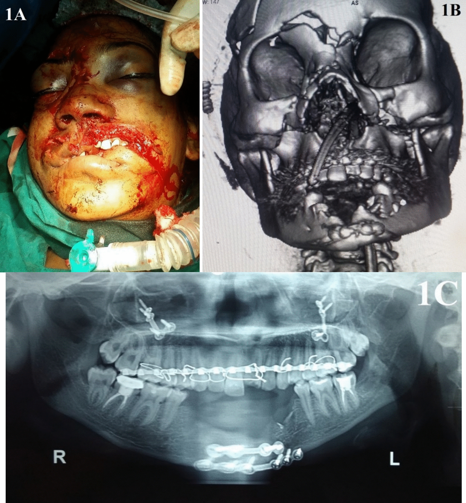 Comprehensive Rehabilitation of Post-traumatic Composite Anterior Mandibular Deformity with Virtual Surgery Guided Vertical Alveolar Distraction Osteogenesis