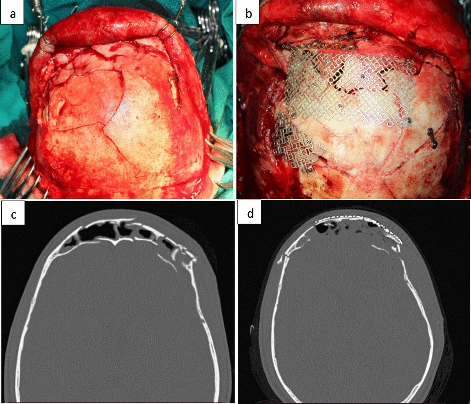 Assessment of Clinical Outcomes of Frontal Bone Fractures: A Prospective Clinical Study