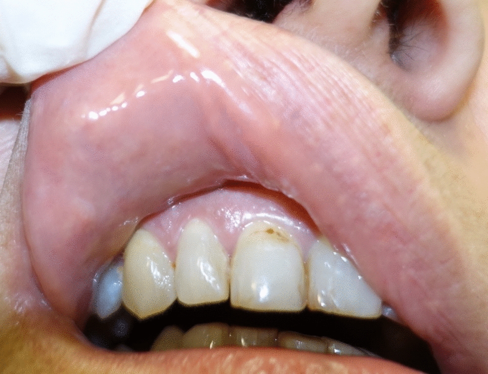 Chronic Viral Infections and Development of Vascular Malformations/Tumors of Head and Neck: Is There a Correlation?