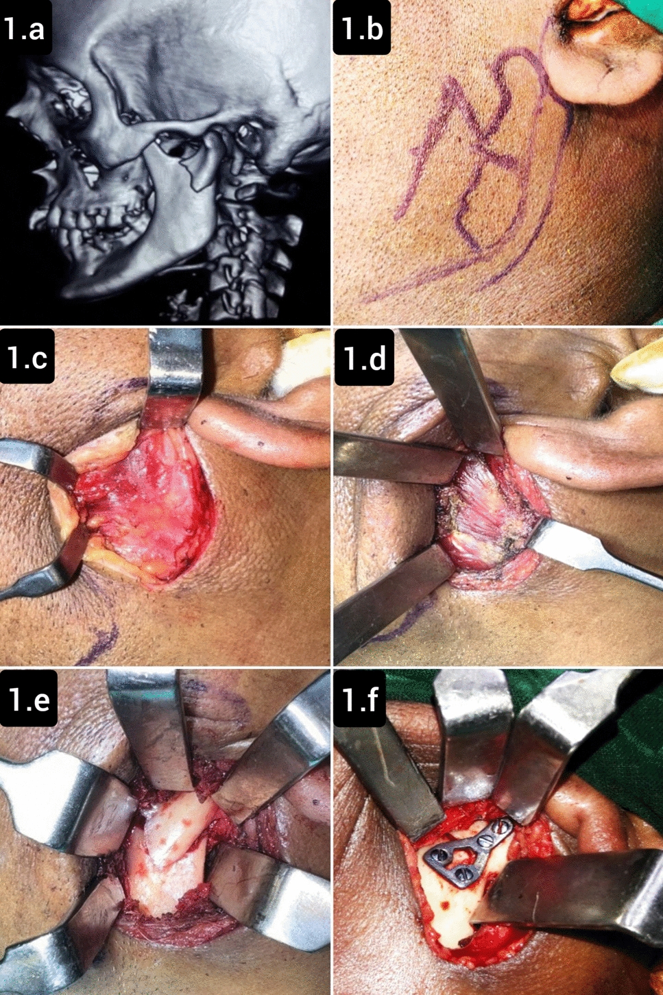 Surgical Management of Condylar Fractures by Retromandibular Transparotid Approach and Transmasseteric Anteroparotid Approach: a Prospective Comparative Study