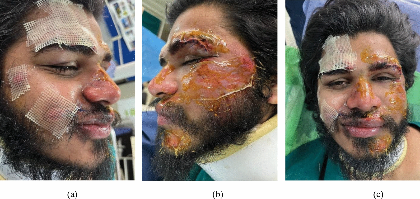 Efficacy of Topical Insulin Gel Dressing Versus Collagen Dressing in Treating Facial Soft Tissue Abrasions: A Split Face Clinical Study