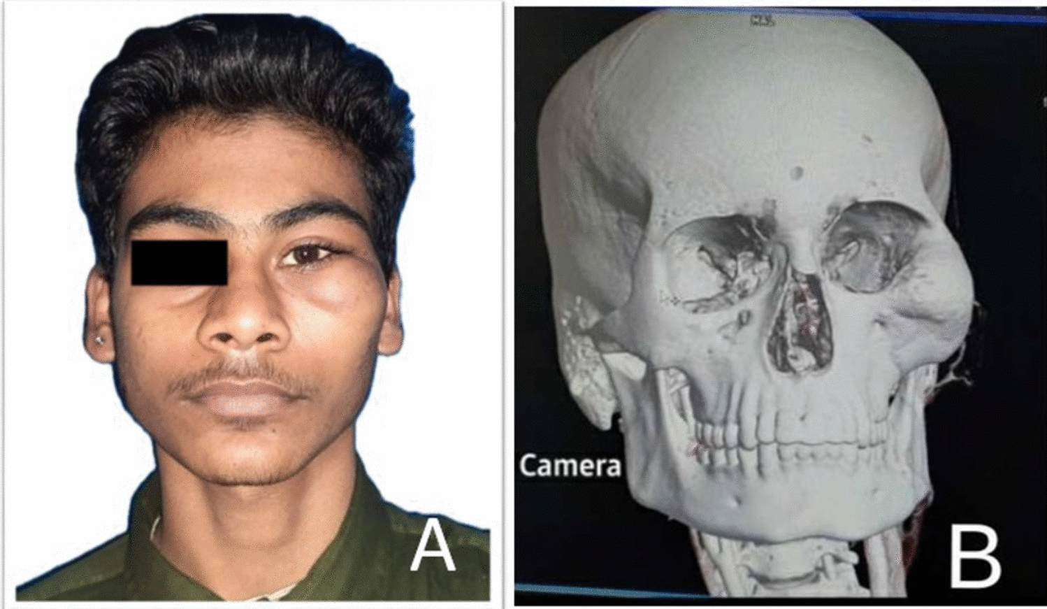 Intraosseous Hemangioma of Zygomatic Bone Involving the Inferolateral Part of Orbit: A Case Report