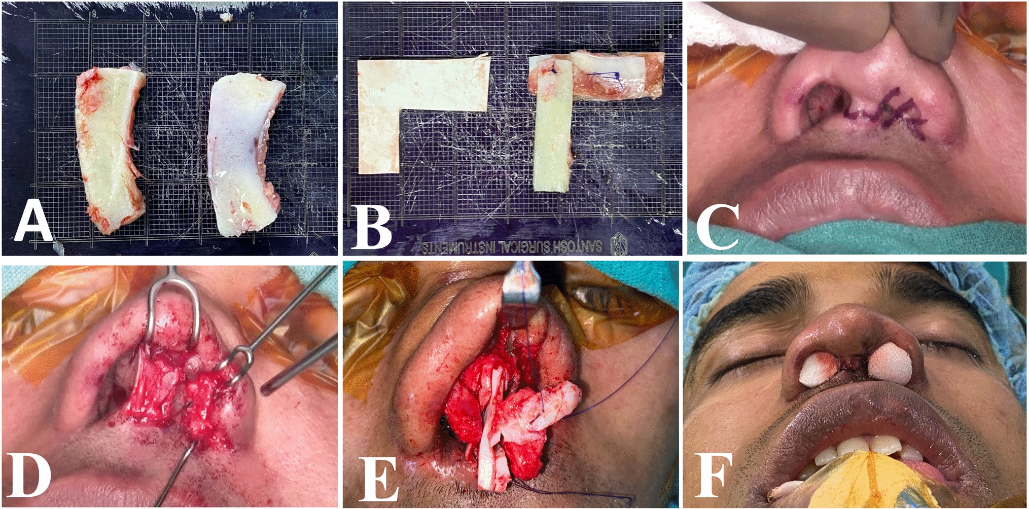 Complete Vestibular Stenosis: A Real Challenge in Rhinoplasty