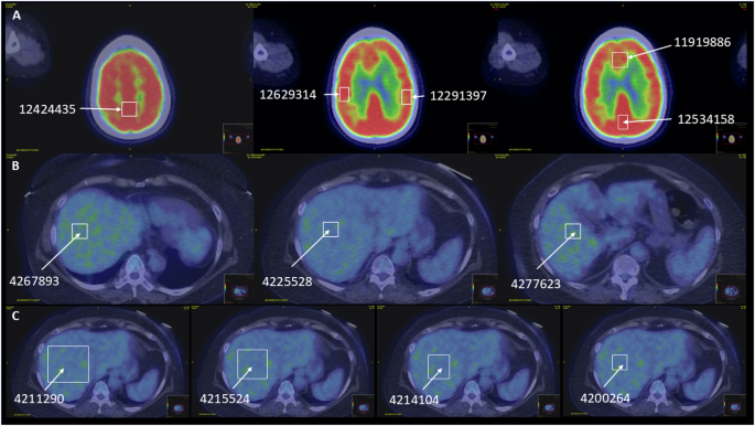 The ratio of brain to liver glucose activity and disease activity in multiple myeloma