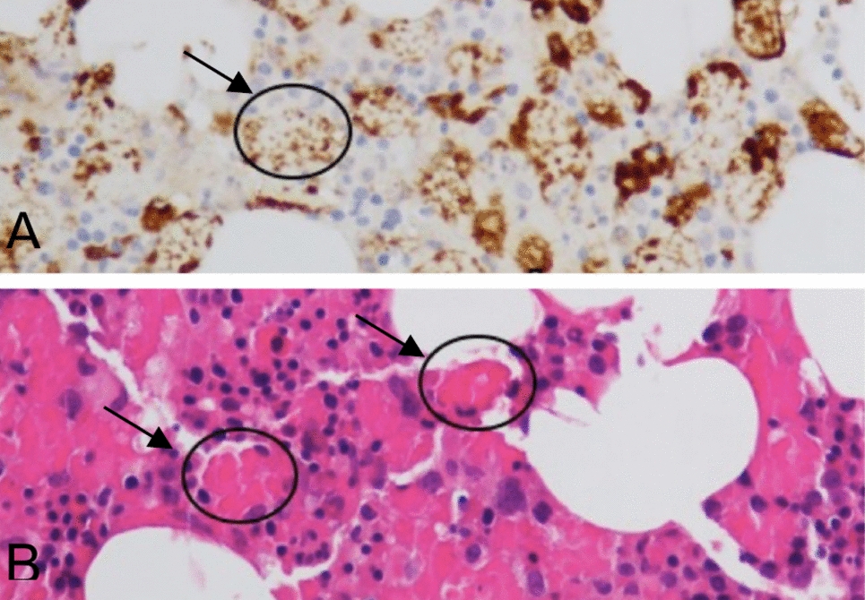 Systemic autoinflammatory disease following COVID-19 mRNA vaccine: a severe and rare clinical presentation