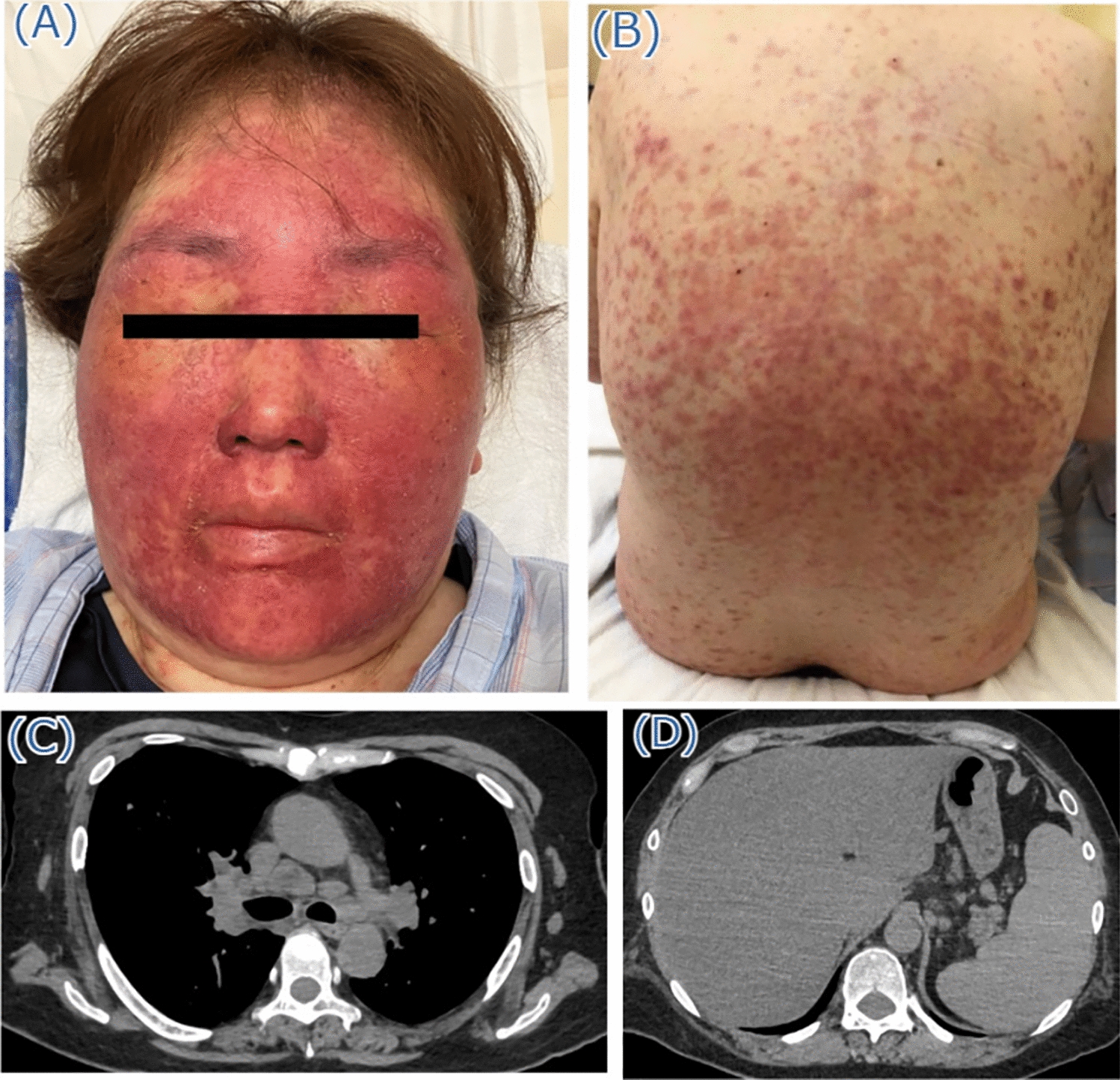 Drug reaction with eosinophilia and systemic symptoms