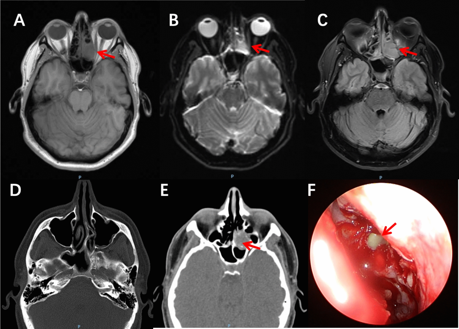 Recurrent headache mimicking cluster headache: a diagnostic challenge