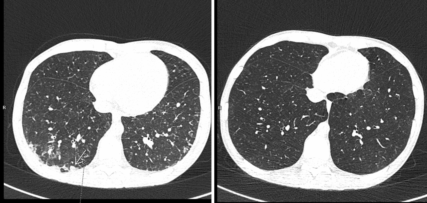 Severe form of an acute schistosomiasis with involvement of the gastrointestinal tract and lungs complicated by Clostridioides difficile infection