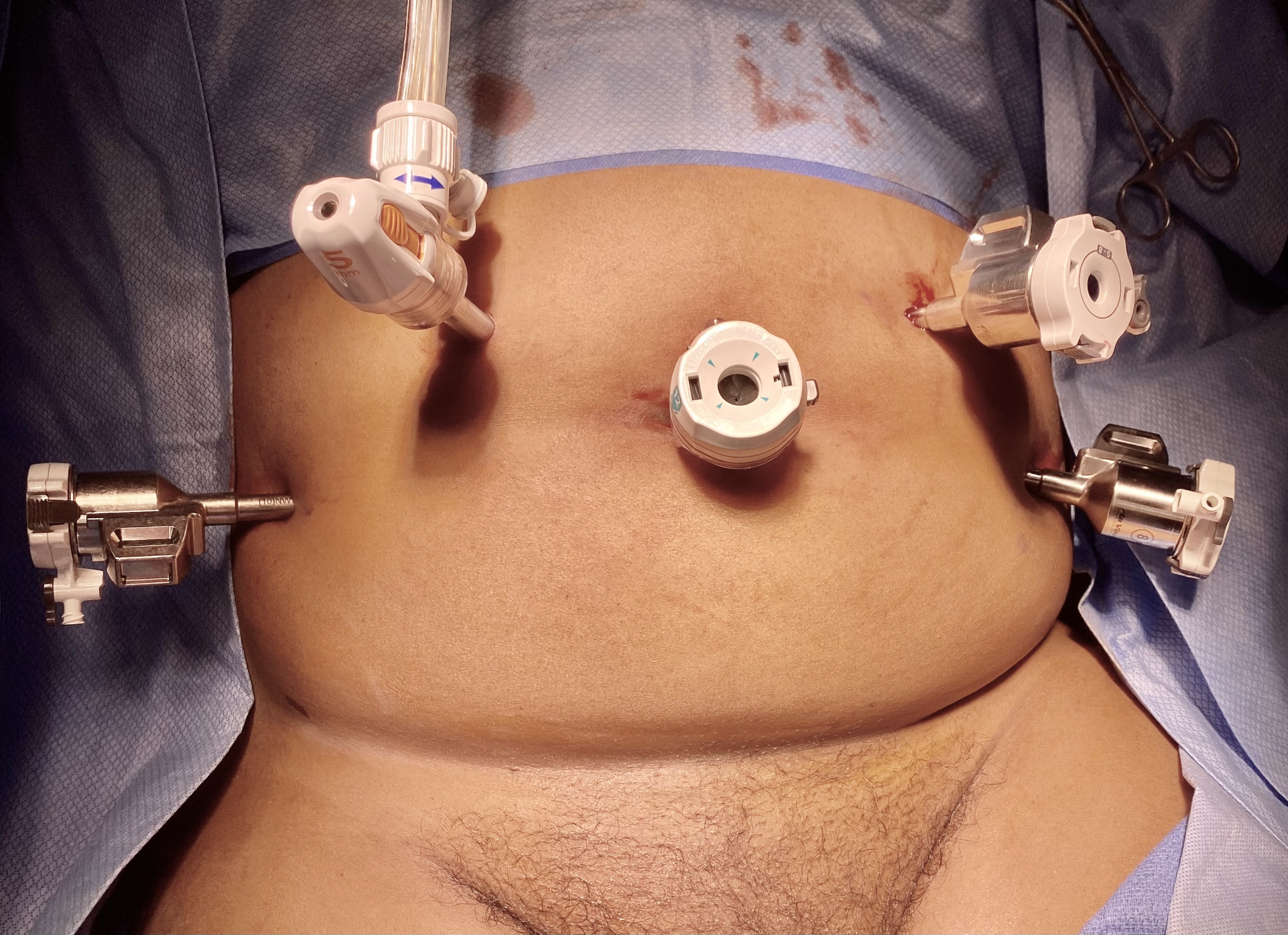 Laparoscopic and Robot-assisted Myomectomy: Optimization and Setup for Success